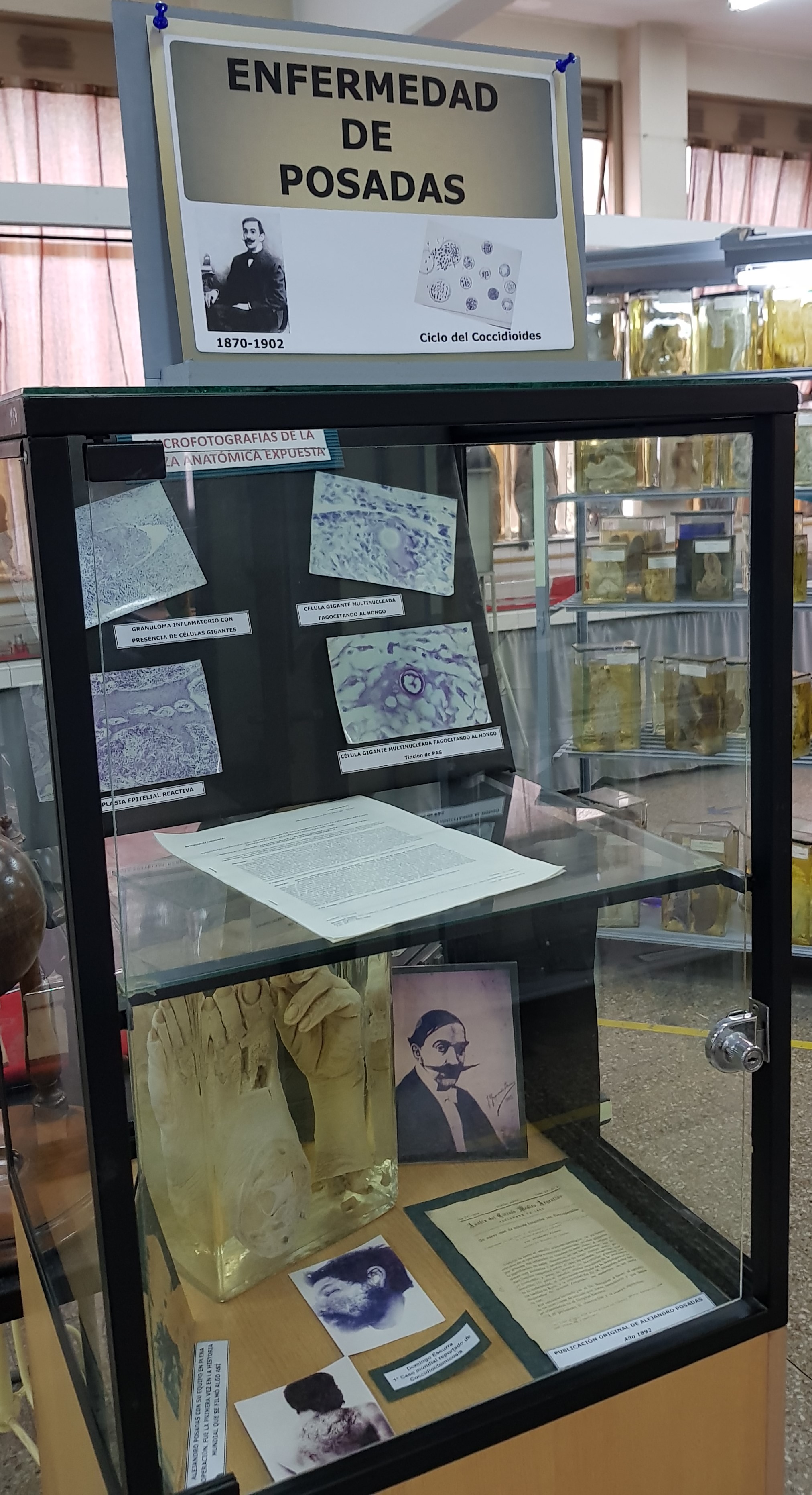 Enfermedad de Posadas