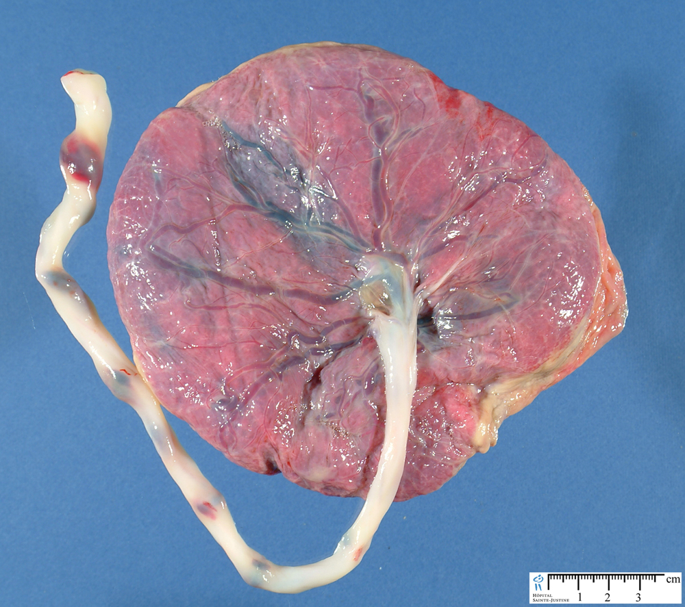 Cara fetal de placenta