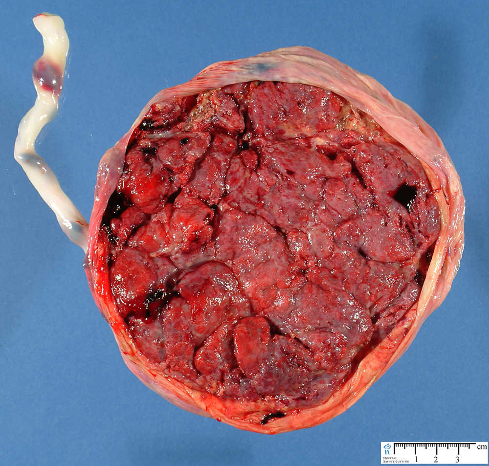 Cara materna de placenta